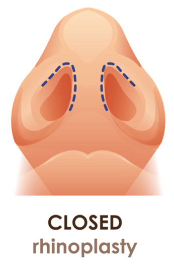 ทำจมูก semi open