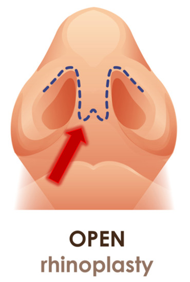 การเปิดแผลจมูกแบบ open